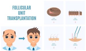 hair transplant