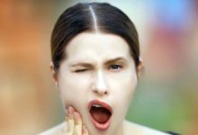 wisdom teeth extraction