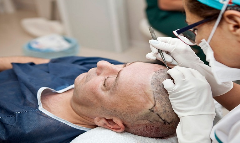 hair transplant in karachi