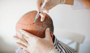 hair transplant in karachi