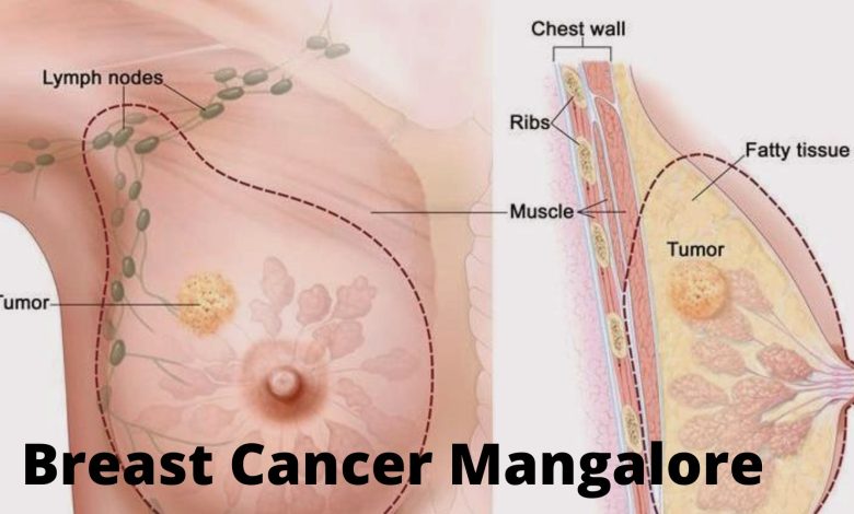 Breast Cancer Mangalore