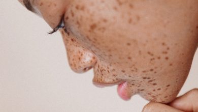 laser freckles removal for skin perfection