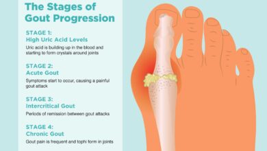 Gout Symptoms